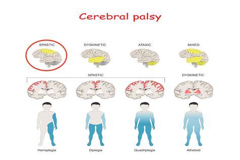 what diseases are similar to cerebral palsy
